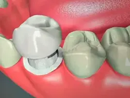 Dental Crown Dental Crown