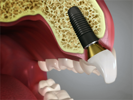 Dental Implants Dental Implants