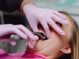 Tooth Extraction Tooth Extraction